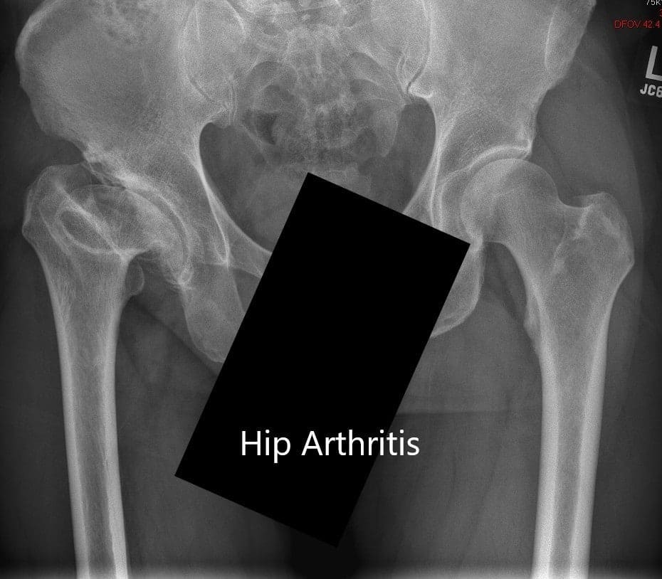 Preoperative X-ray showing the AP view of the pelvis with both hip joints Preoperative X-ray showing the AP view of the pelvis with both hip joints
