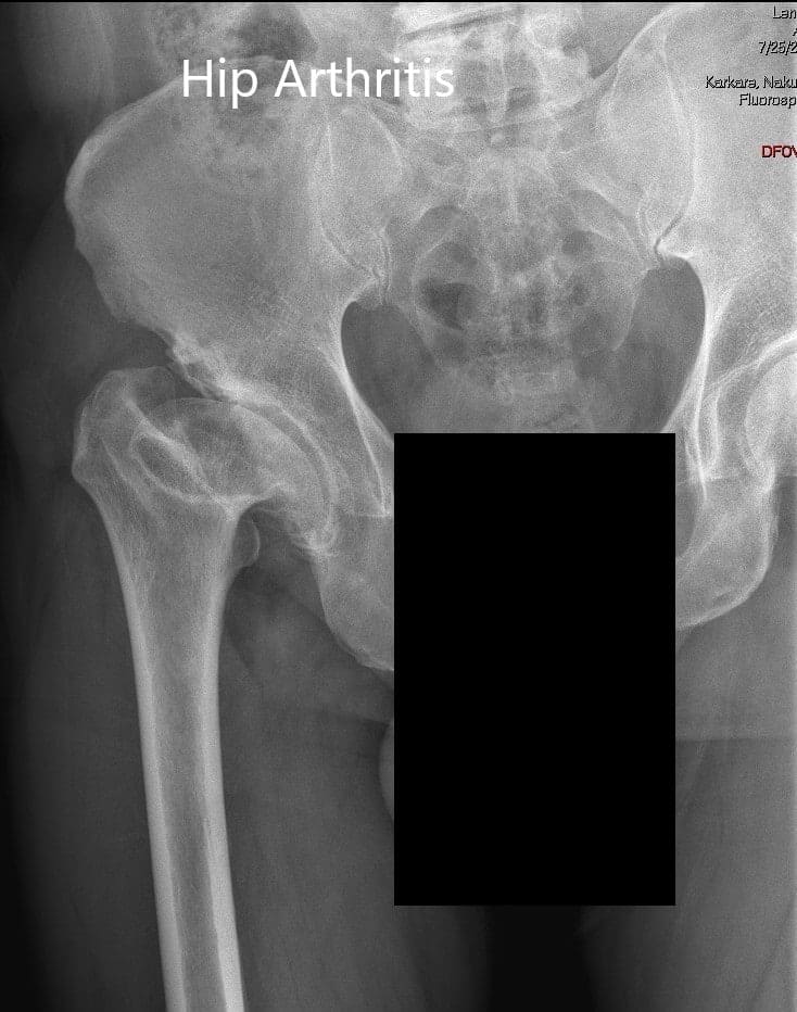 AP and lateral views of the right hip joint AP and lateral views of the right hip joint