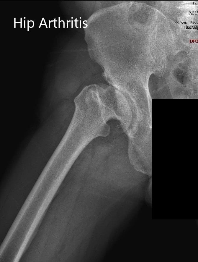 AP and lateral views of the right hip joint - img 2 AP and lateral views of the right hip joint - img 2