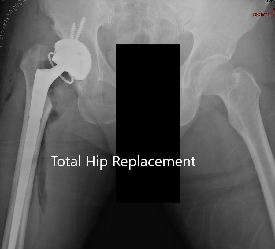 Postoperative X-ray showing AP view of the pelvis Postoperative X-ray showing AP view of the pelvis