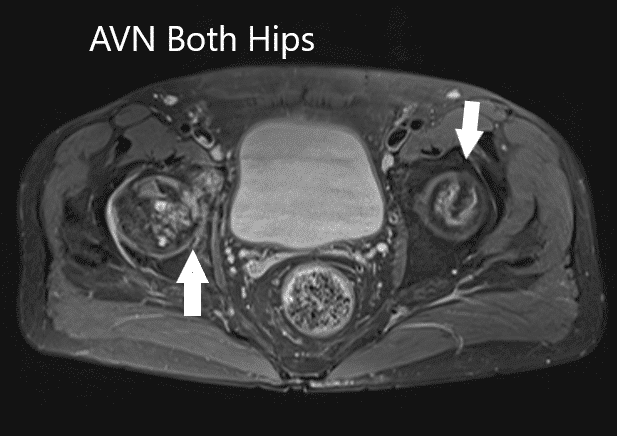 Axial section T2WI showing bilateral AVN of the femoral heads Axial section T1WI showing bilateral AVN of the femoral heads