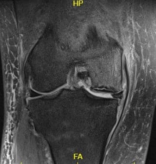 T2 weighted image showing the coronal section of the knee with altered bone marrow signal and rim sign T2 weighted image showing the coronal section of the knee with altered bone marrow signal and rim sign