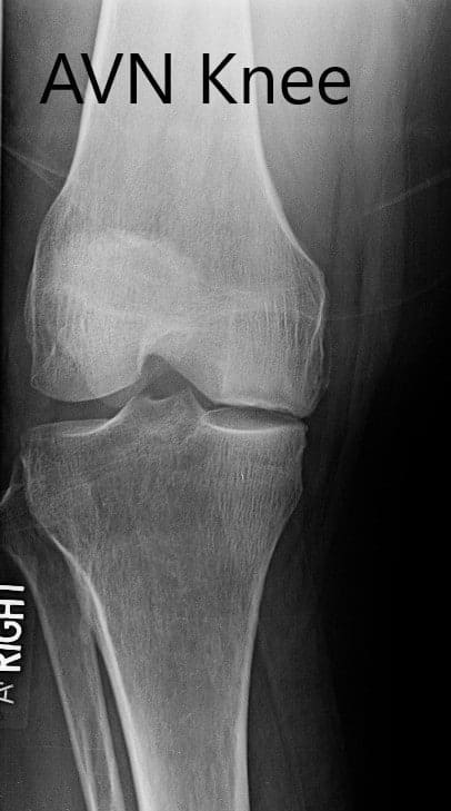 Preoperative X-ray of the right knee in anteroposterior and lateral views Preoperative X-ray of the right knee in anteroposterior and lateral views
