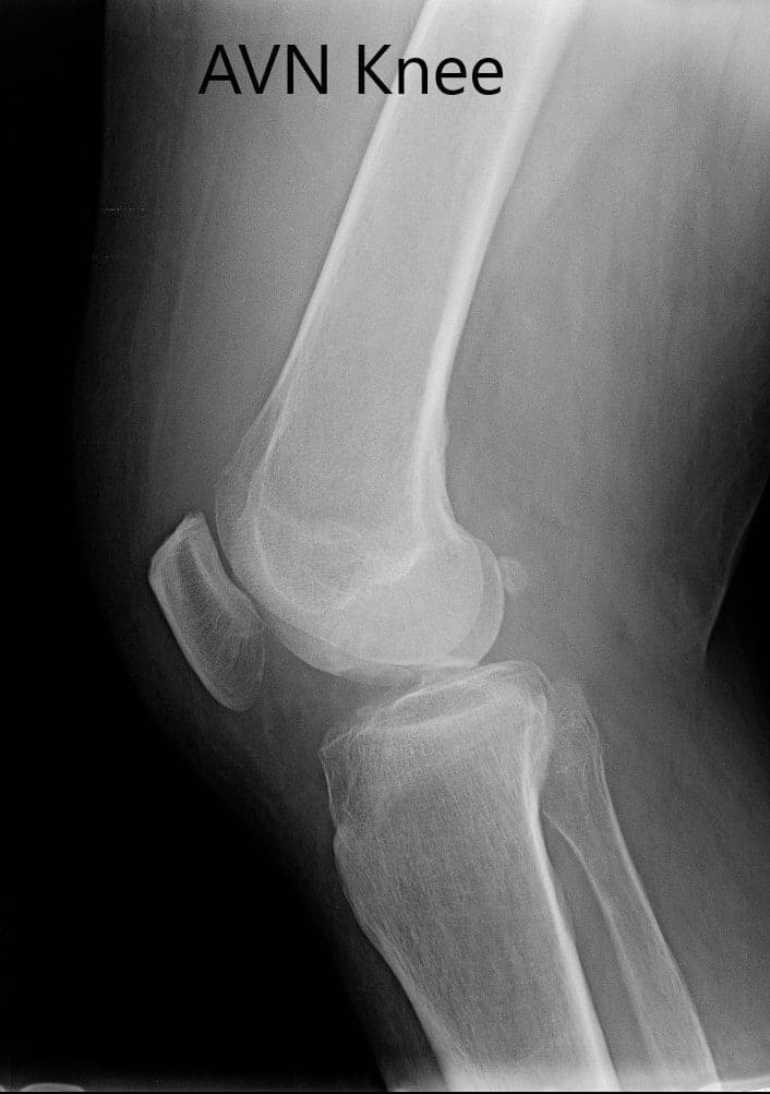 Preoperative X-ray of the right knee in anteroposterior and lateral views - img 2 Preoperative X-ray of the right knee in anteroposterior and lateral views - img 2