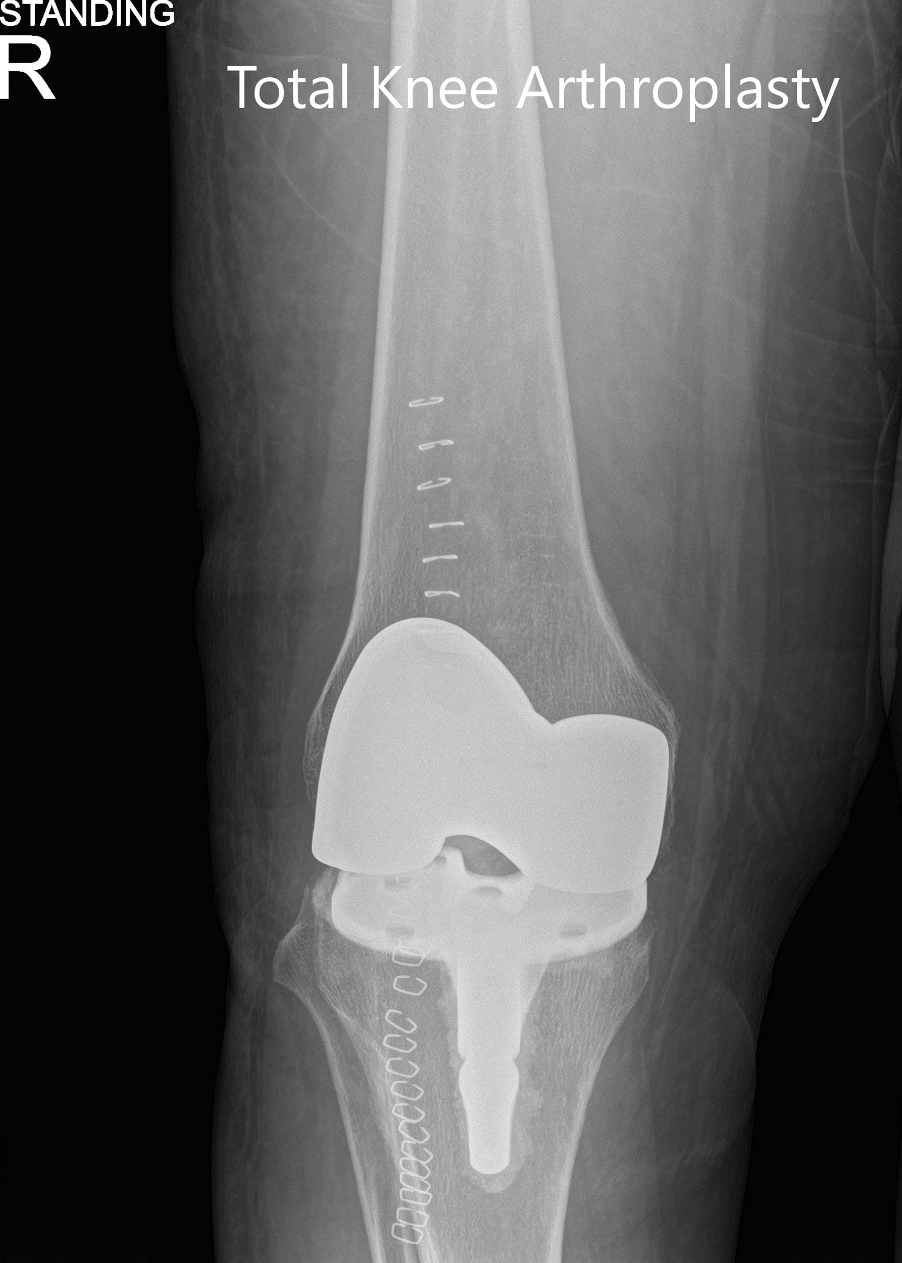 Postoperative x-ray showing the anteroposterior and lateral views of the right knee. Postoperative x-ray showing the anteroposterior and lateral views of the right knee