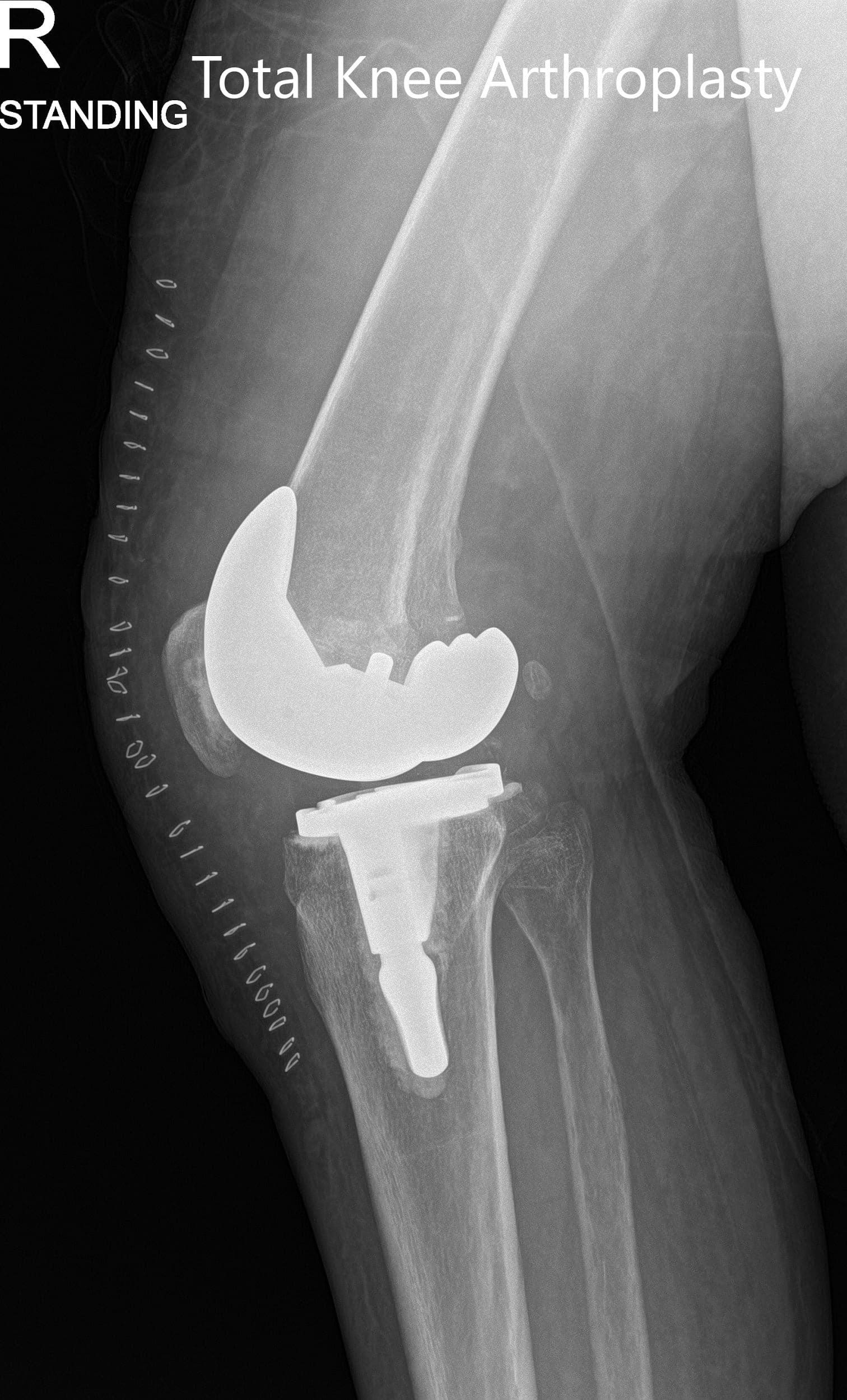 Postoperative x-ray showing the anteroposterior and lateral views of the right knee - img 2 Postoperative x-ray showing the anteroposterior and lateral views of the right knee - img 2