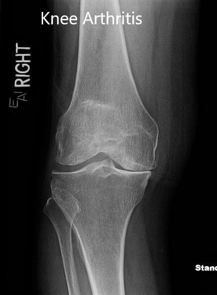 Preoperative X-ray showing the anteroposterior and lateral view of the right knee.Preoperative X-ray showing the anteroposterior and lateral view of the right knee Preoperative X-ray showing the anteroposterior and lateral view of the right knee.Preoperative X-ray showing the anteroposterior and lateral view of the right knee