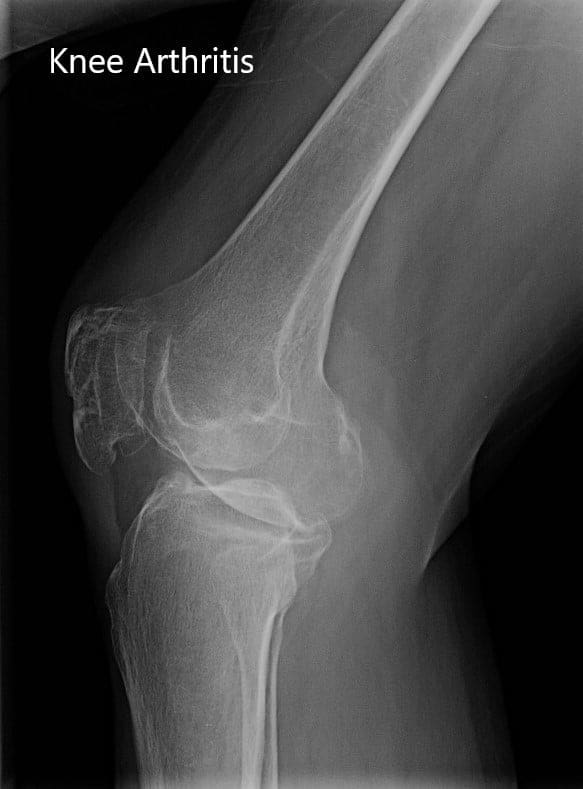 Preoperative X-ray showing the anteroposterior and lateral view of the right knee.Preoperative X-ray showing the anteroposterior and lateral view of the right knee - img 2 Preoperative X-ray showing the anteroposterior and lateral view of the right knee.Preoperative X-ray showing the anteroposterior and lateral view of the right knee - img 2