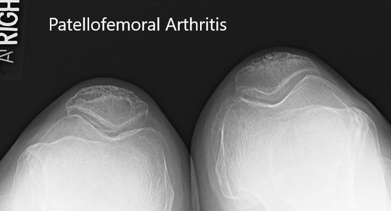 Preoperative x-ray showing the merchant view of both the knees Preoperative x-ray showing the merchant view of both the knees