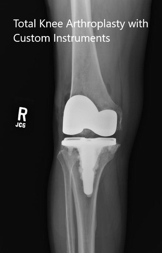 Postoperative x-rays showing the anteroposterior and lateral views of the right knee Postoperative x-rays showing the anteroposterior and lateral views of the right knee