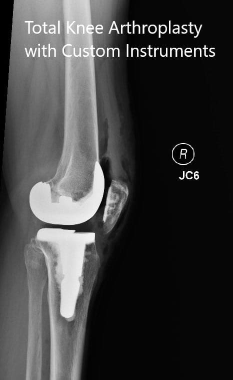 Postoperative x-rays showing the anteroposterior and lateral views of the right knee - img 2 Postoperative x-rays showing the anteroposterior and lateral views of the right knee - img 2