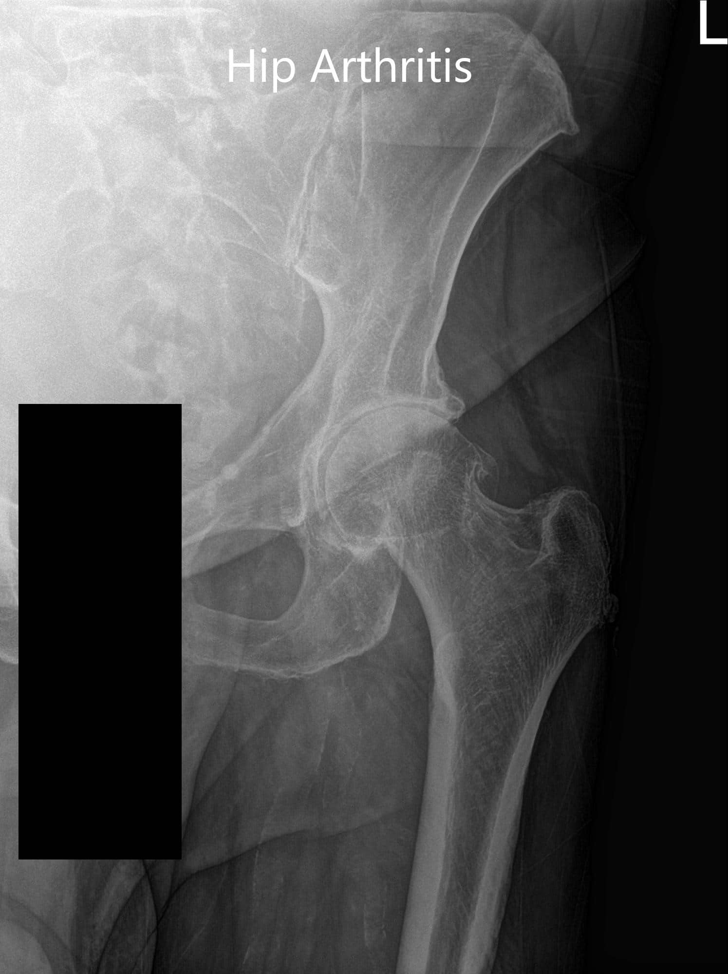 Preoperative X-ray of the left hip showing AP and frog-legged lateral view Preoperative X-ray of the left hip showing AP and frog-legged lateral view