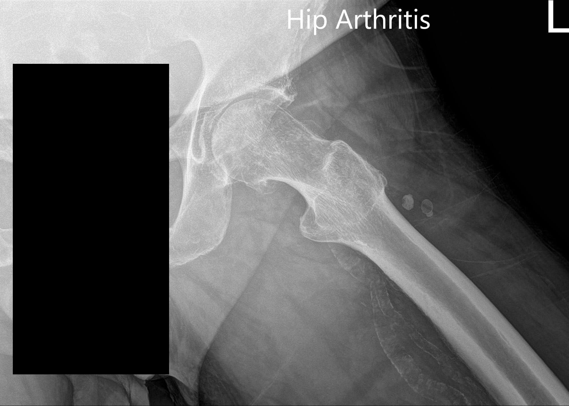 Preoperative X-ray of the left hip showing AP and frog-legged lateral view - img 2 Preoperative X-ray of the left hip showing AP and frog-legged lateral view - img 2