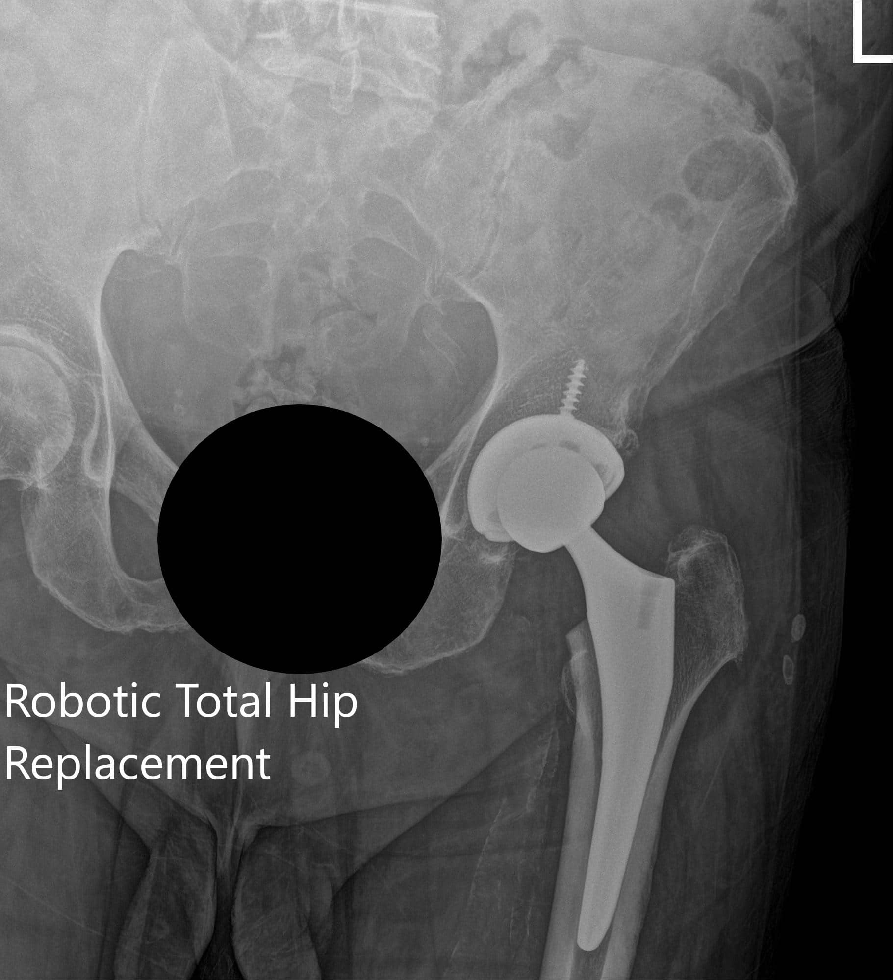 Postoperative X-ray of the left hip showing AP and frog-legged lateral view Postoperative X-ray of the left hip showing AP and frog-legged lateral view