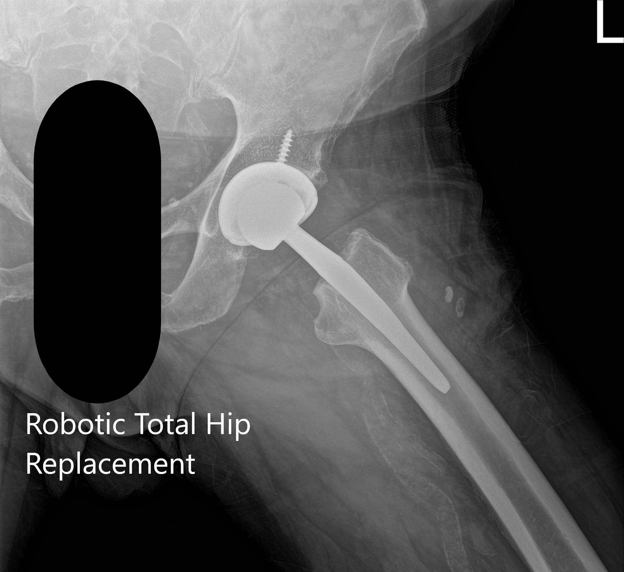Postoperative X-ray of the left hip showing AP and frog-legged lateral view - img 2 Postoperative X-ray of the left hip showing AP and frog-legged lateral view - img 2