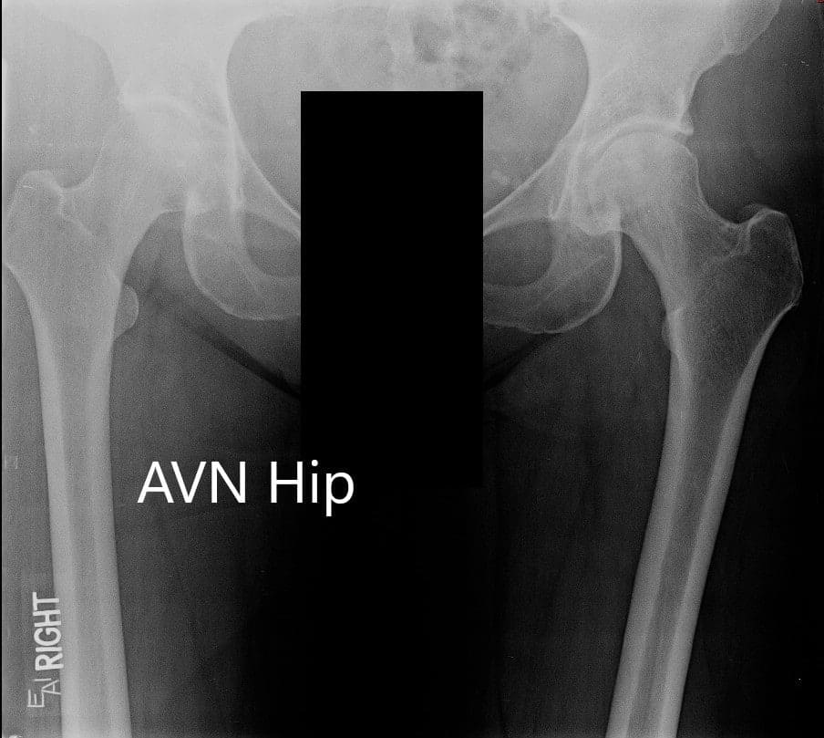 Radiografía que muestra la vista AP de la pelvis con ambas articulaciones de la cadera Radiografía que muestra la vista AP de la pelvis con ambas articulaciones de la cadera