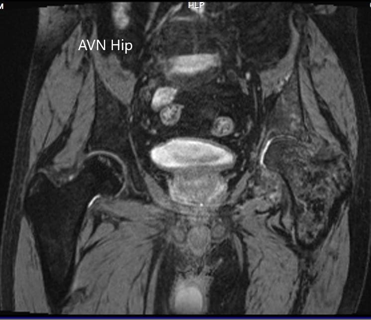 MRI showing the T2WI of the pelvis MRI showing the T2WI of the pelvis