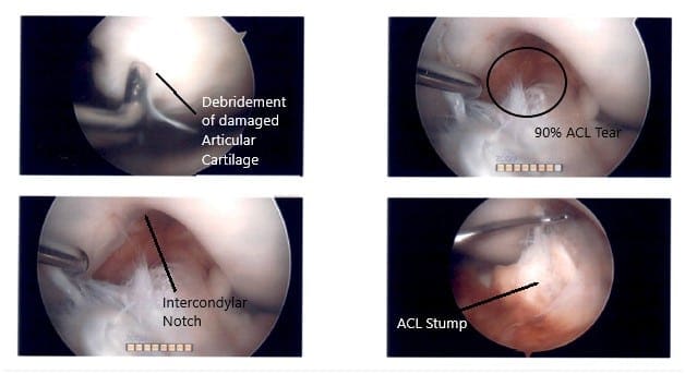 Imágenes artroscópicas intraoperatorias de la rodilla izquierda Imágenes artroscópicas intraoperatorias de la rodilla izquierda