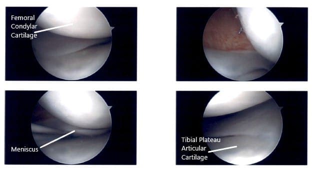 Imágenes artroscópicas intraoperatorias de la rodilla izquierda 2 Imágenes artroscópicas intraoperatorias de la rodilla izquierda 2