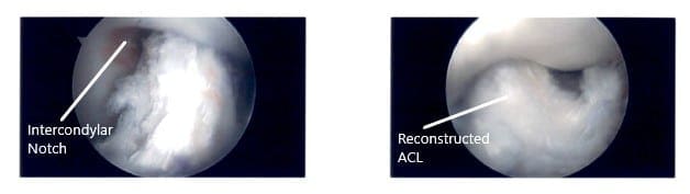Imágenes artroscópicas intraoperatorias de la rodilla izquierda 3 Imágenes artroscópicas intraoperatorias de la rodilla izquierda 3