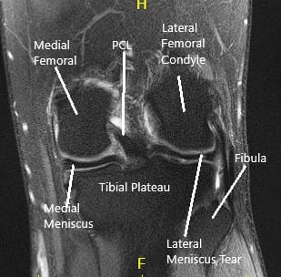 Resonancia magnética de rodilla en secciones coronal y sagital Resonancia magnética de rodilla en secciones coronal y sagital