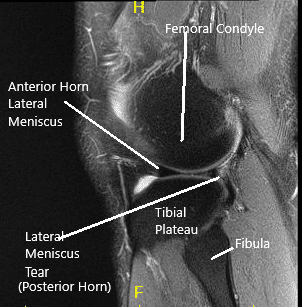 Resonancia magnética de rodilla en secciones coronal y sagital 2 Resonancia magnética de rodilla en secciones coronal y sagital 2