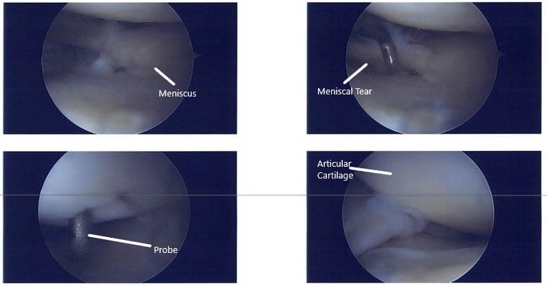 Imágenes artroscópicas intraoperatorias Imágenes artroscópicas intraoperatorias