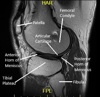 Sagittal MRI view of the left knee Sagittal MRI view of the left knee