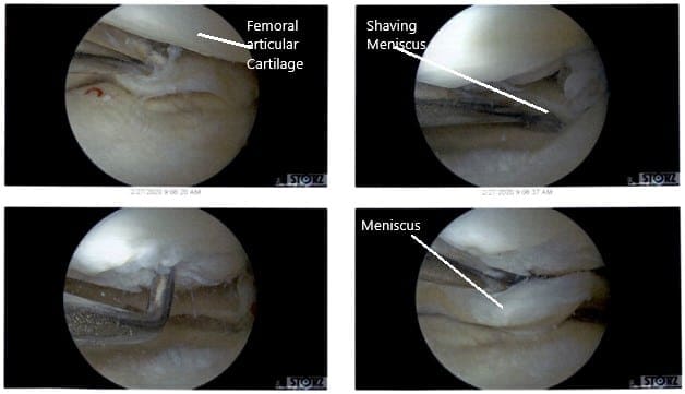 Intraoperative Arthroscopic Views of the left knee 2 Intraoperative Arthroscopic Views of the left knee 2