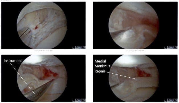 Intraoperative Arthroscopic Views of the left knee 3 Intraoperative Arthroscopic Views of the left knee 3