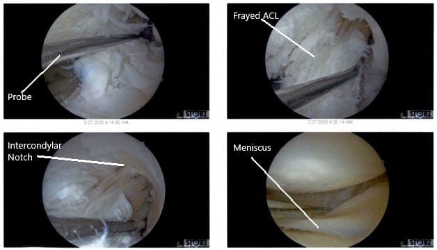 Intraoperative Arthroscopic Views of the left knee 4 Intraoperative Arthroscopic Views of the left knee 4