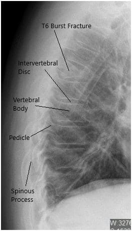 Radiografía preoperatoria de la columna toracolumbar en vista lateral Radiografía preoperatoria de la columna toracolumbar en vista lateral