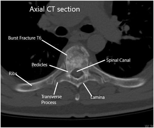TAC preoperatorio de la columna toracolumbar en sección axial en T6 TAC preoperatorio de la columna toracolumbar en sección axial en T6
