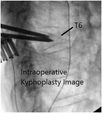 Imágenes de fluoroscopia intraoperatoria Imágenes de fluoroscopia intraoperatoria