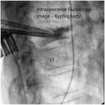 Imágenes de fluoroscopia intraoperatoria 2 Imágenes de fluoroscopia intraoperatoria 2