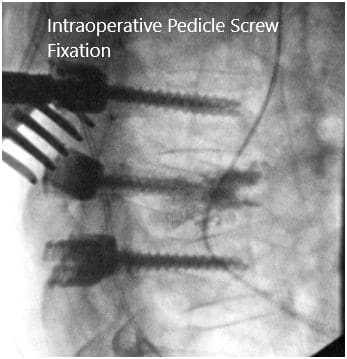 Imágenes fluoroscópicas intraoperatorias 3 Imágenes fluoroscópicas intraoperatorias 3