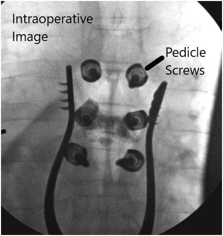 Imágenes fluoroscópicas intraoperatorias 4 Imágenes fluoroscópicas intraoperatorias 4