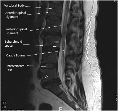 Resonancia magnética de la columna lumbosacra en vistas sagital y axial