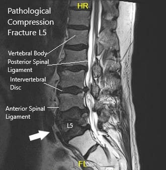 Resonancia magnética que muestra sección sagital de la columna lumbar sacra Resonancia magnética que muestra sección sagital de la columna lumbar sacra