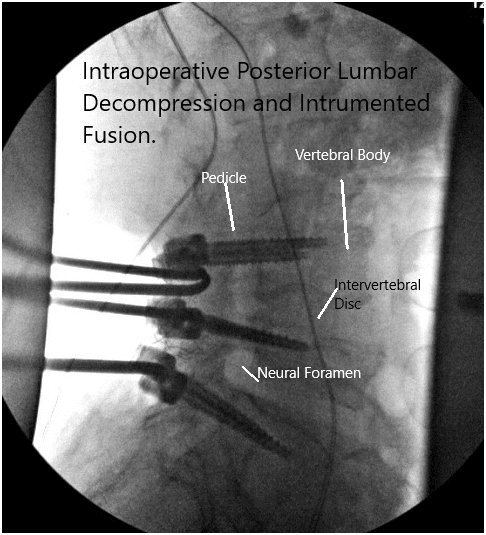 Imágenes de fluoroscopia intraoperatoria 2 Imágenes de fluoroscopia intraoperatoria 2
