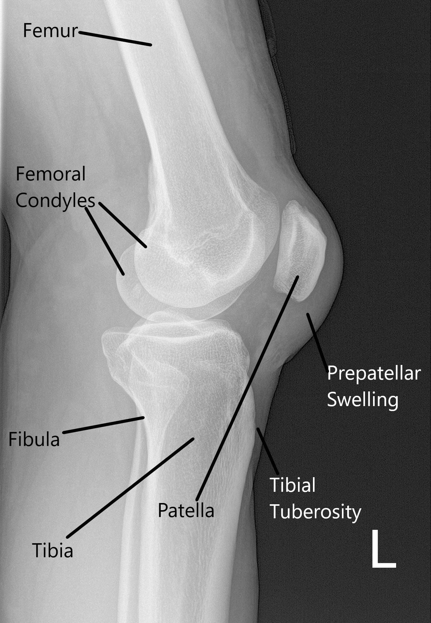 Radiografía de la rodilla izquierda en vista lateral Radiografía de la rodilla izquierda en vista lateral