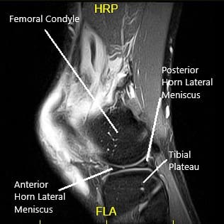 Resonancia magnética de la rodilla izquierda en la vista sagital y coronal Resonancia magnética de la rodilla izquierda en la vista sagital y coronal
