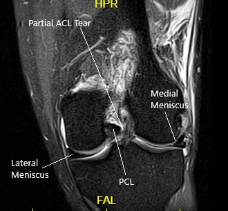 Resonancia magnética de la rodilla izquierda en la vista sagital y coronal 2 Resonancia magnética de la rodilla izquierda en la vista sagital y coronal 2