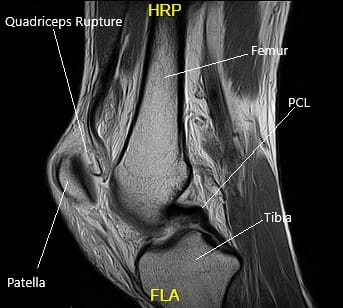 Resonancia magnética de la rodilla izquierda en la sección sagital Resonancia magnética de la rodilla izquierda en la sección sagital