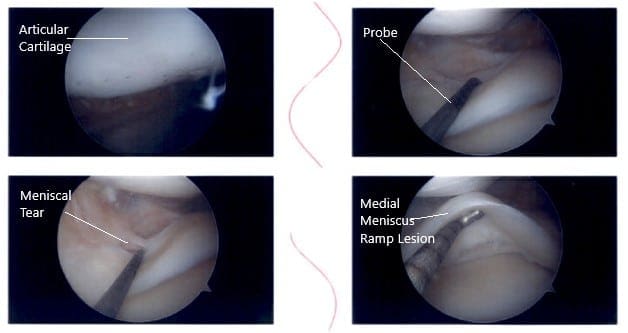 Intraoperative knee arthroscopic images Intraoperative knee arthroscopic images