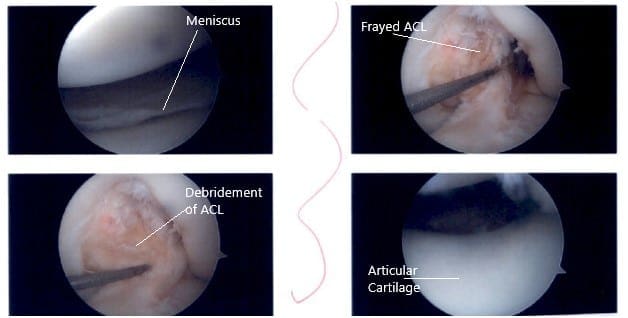 Intraoperative knee arthroscopic images 3 Intraoperative knee arthroscopic images 3