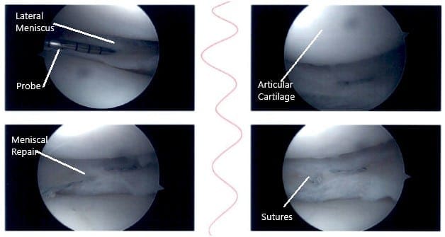 Intraoperative knee arthroscopic images 4 Intraoperative knee arthroscopic images 4