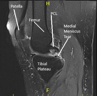 MRI of the right knee suggested medial meniscus tear and patellofemoral arthritis of the right knee 3 MRI of the right knee suggested medial meniscus tear and patellofemoral arthritis of the right knee 3