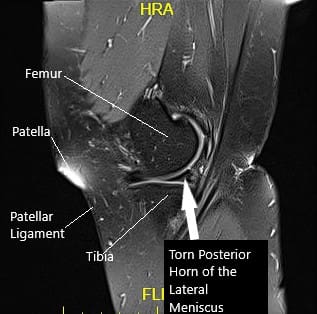 Imagen sagital de la rodilla izquierda con resonancia magnética sagital Imagen sagital de la rodilla izquierda con resonancia magnética sagital