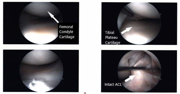 Imágenes artroscópicas intraoperatorias de la rodilla izquierda 2 Imágenes artroscópicas intraoperatorias de la rodilla izquierda 2